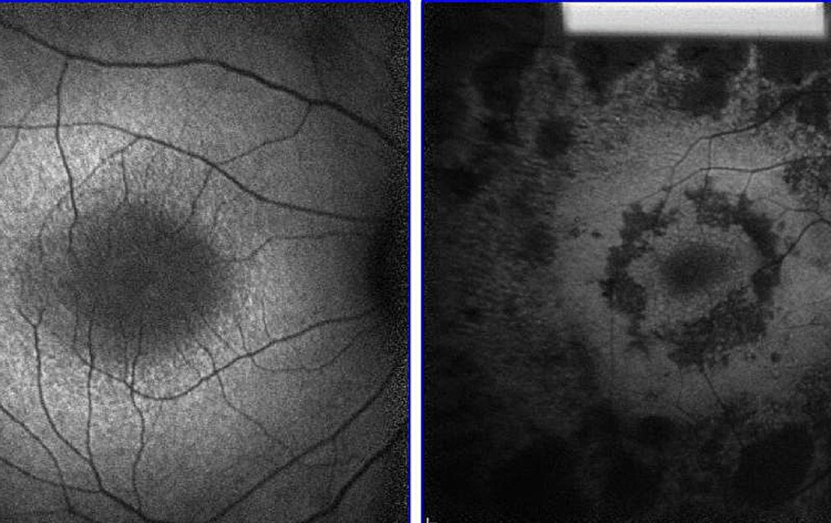 Universal Treatment Approach May Be on Horizon for Retinitis Pigmentosa